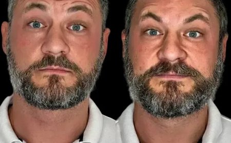 Anchor Radiance via Profhilo and Best Doctors in dubai