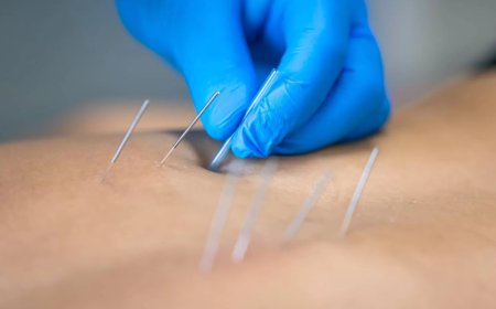 Discover the Power of Dry Needles at Dynasty Clinic