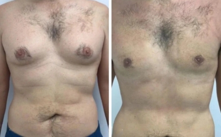 Gynecomastia Surgery in Dubai: What Are the Best Techniques Available?