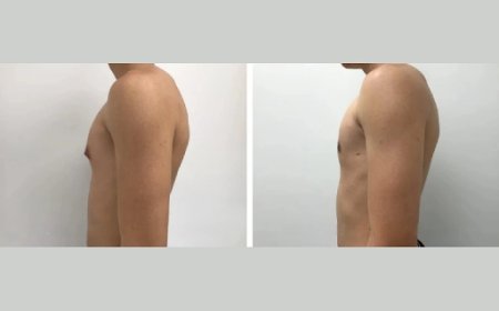 What Is Gynecomastia and Why Is It Common Among Men in Dubai?