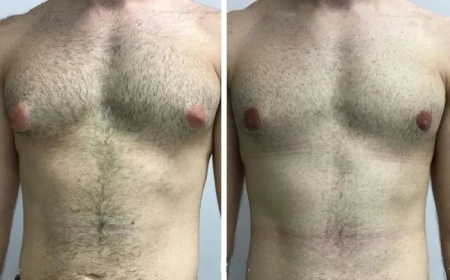Minimally Invasive Techniques Used by the Best Gynecomastia Surgeon in Dubai