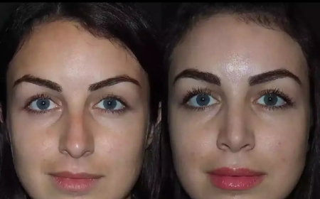 Is Nose Deviated Septum Surgery in Dubai Painful?