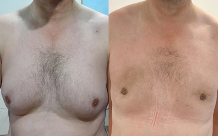 Affordable Options for Gynecomastia Surgery in Islamabad