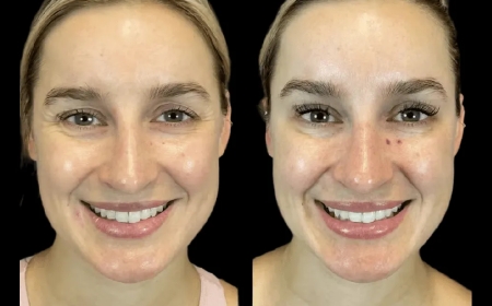 Is Botox Right for You? Insights from the Best Doctors in Dubai