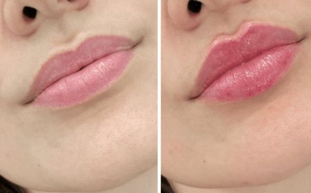 How Juvederm Helps Restore Volume and Contours: A Detailed Guide from the Best Plastic Surgeon in Dubai