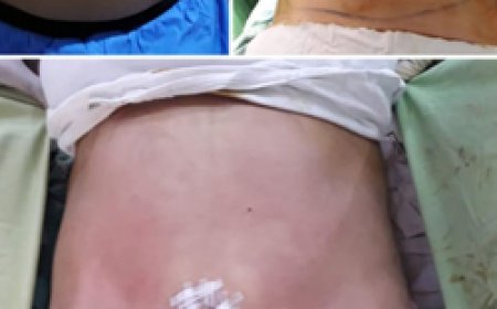 Affordable vs. Premium: Comparing Liposuction Cost in Pakistan