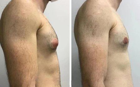 How to Determine if You’re a Candidate for Gynecomastia in Dubai Surgery