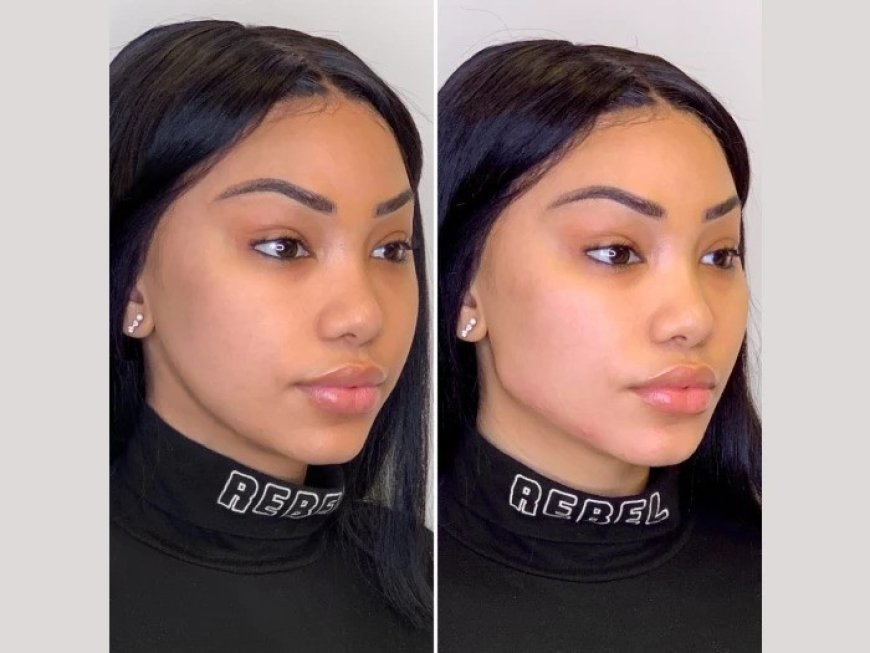 Best Doctors in Dubai for Thread Lift: How to Restore Skin Tightness and Firmness Non-Surgically