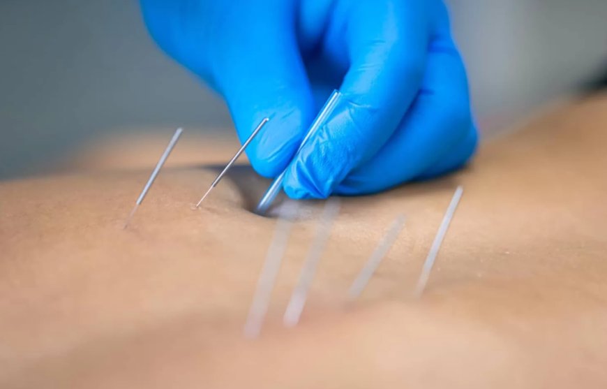 Discover the Power of Dry Needles at Dynasty Clinic