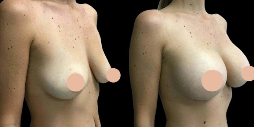Breast Augmentation in Dubai: The Luxury Experience You Deserve