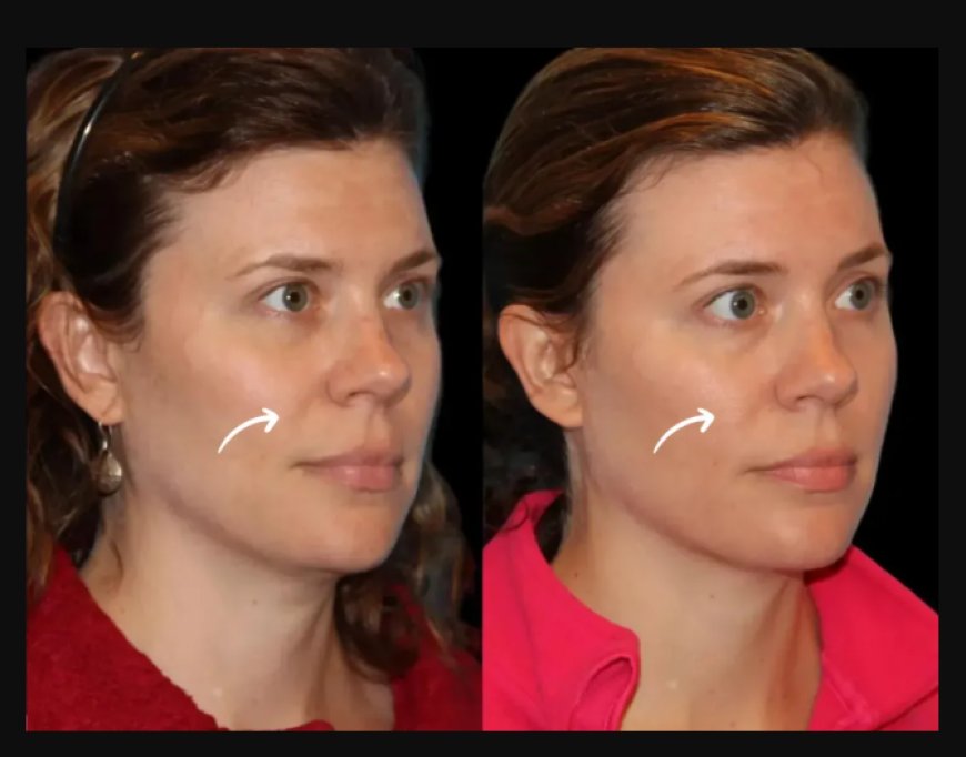 Why Dubai's Best Plastic Surgeons See Sculptra Fillers as the "Skin Investment" of the Future