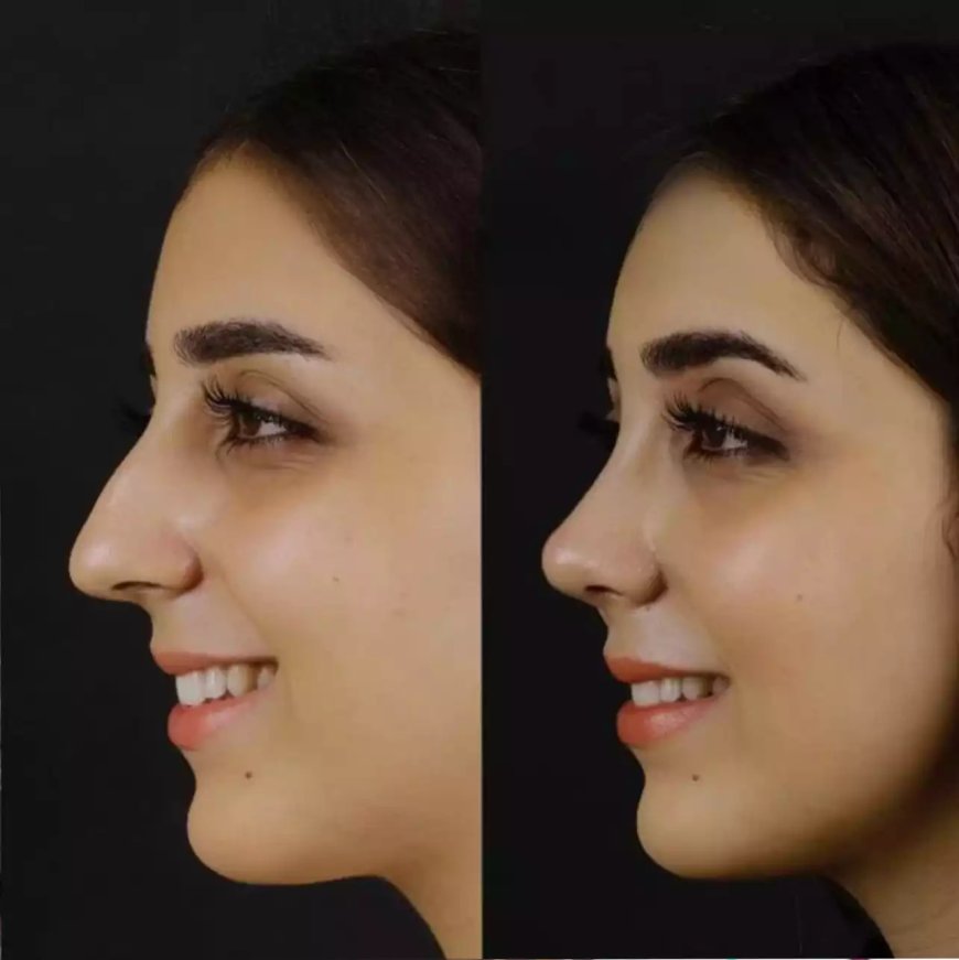 Nose Deviated Septum Surgery in Dubai for Chronic Sinus Relief