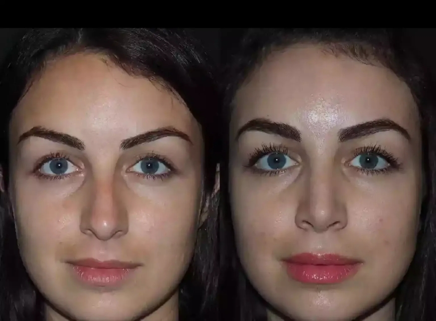 Is Nose Deviated Septum Surgery in Dubai Painful?