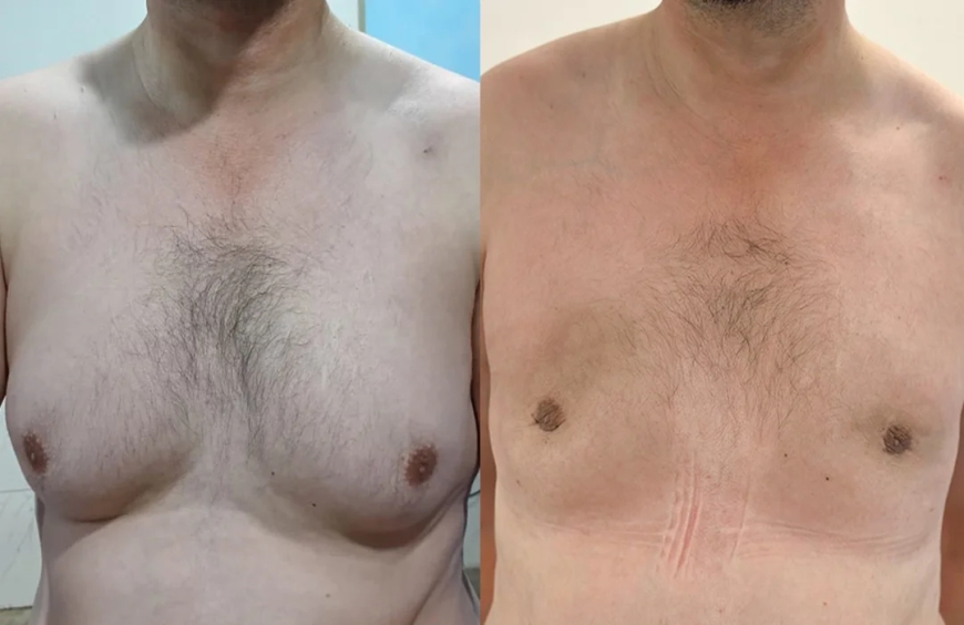 Affordable Options for Gynecomastia Surgery in Islamabad