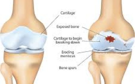 Can Brufen 400 mg Help with Period Cramps? Expert Insights