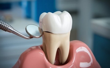 Reclaim Your Smile with Modern Dental Crowns