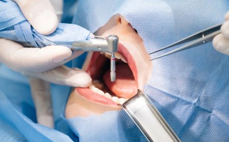 Dental Implants Prevent Bone Loss in Jaw